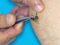 Пчелотерапия (Апитерапия). Укусы пчел.